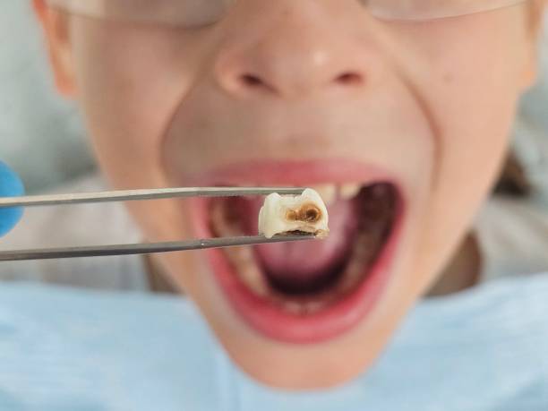 Best Emergency Dental Care for Abscessed Tooth in Slippery Rock, PA